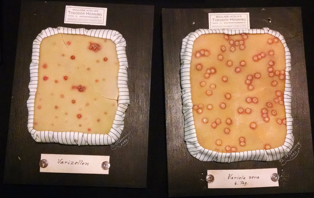 Wax molds depicting chickenpox by Theodor Henning (1922)