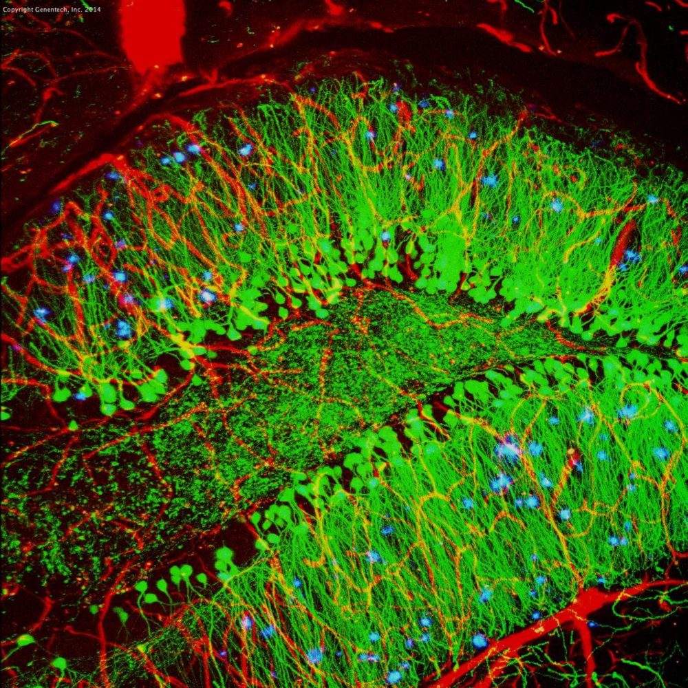 photo of Brain showing hallmarks of Alzheimer’s disease (plaques in blue)